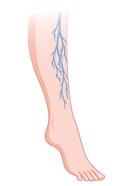 Plik wektorowy Żylaki niebieskie naczynia krwionośne widoczne przez skórę nieprawidłowo opuchnięta noga diagnostyka i leczenie chorób naczyniowych choroba chorobowa niewydolności żylnej