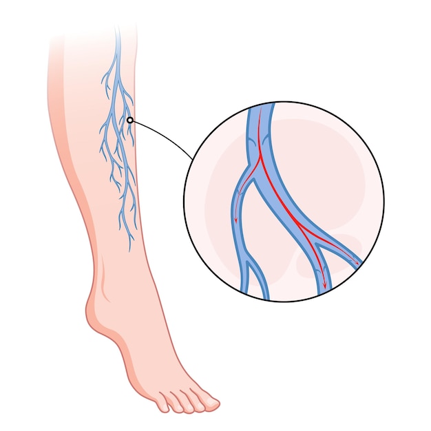 Plik wektorowy Żylaki niebieskie naczynia krwionośne widoczne przez skórę nieprawidłowo opuchnięta noga diagnostyka i leczenie chorób naczyniowych choroba chorobowa niewydolności żylnej