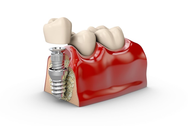 3d ilustracja modelu implantu dentystycznego zęba