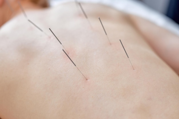 Akupunktura na plecach kręgosłupa barków dla kobiety klientka kobieta poddawana akupunkturze