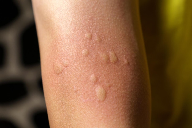 Alergia na teksturę skóry, reakcja na szczepiona chwasty, objawy alergii, skupienie selektywne