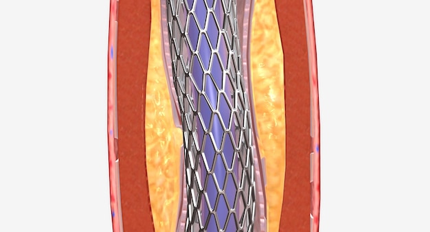 Angioplastyka To Zabieg Mający Na Celu Przywrócenie Przepływu Krwi W Tętnicach