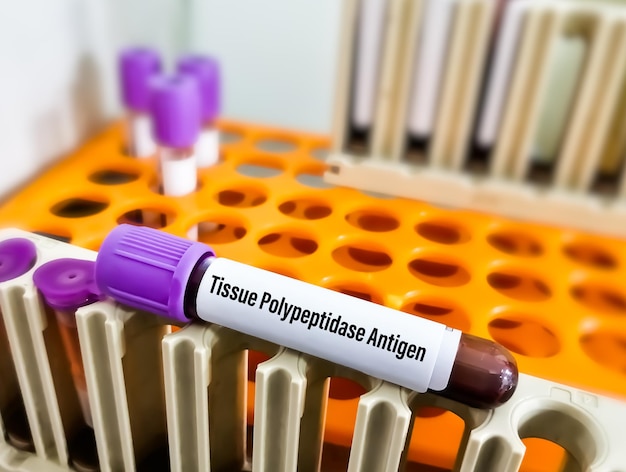 Antygen polipeptydu tkankowego lub test TPA do diagnozy raka układu moczowo-płciowego lub raka pęcherza moczowego