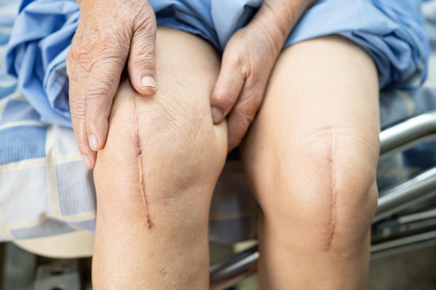 Azjatycka starsza pacjentka pokazuje swoje blizny po operacji całkowitej wymiany stawu kolanowego.