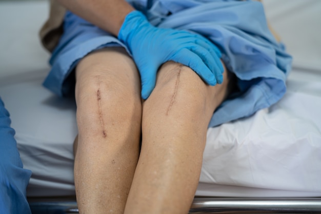 Azjatycka starsza pacjentka pokazuje swoje blizny po operacji całkowitej wymiany stawu kolanowego.