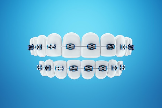 Białe zęby z metalowymi szelkami na niebieskim tle. Aparaty ortodontyczne, leczenie ortodontyczne, stomatologia, wybielanie zębów, ochrona, pielęgnacja jamy ustnej, higiena, opieka zdrowotna. Ilustracja 3D, renderowanie 3D.
