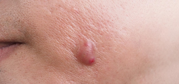 Big Acne Cyst Ropień lub wrzód Opuchnięty obszar w tkance skóry twarzy