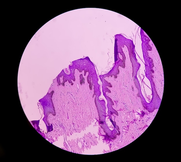 Biopsja histologiczna ściany moszny pod mikroskopem pokazująca Calcinosis cutis. Kalcynoza moszny.