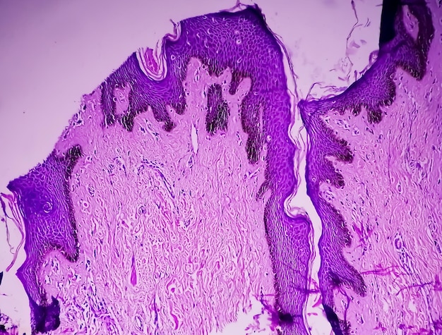 Biopsja histologiczna ściany moszny pod mikroskopem pokazująca Calcinosis cutis. Kalcynoza moszny.