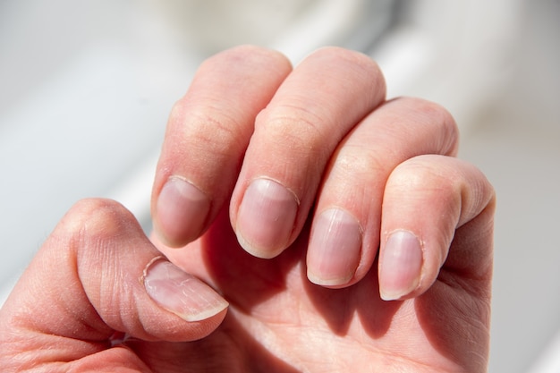 Bliska paznokcie kobiety po złym manicure. Skórki przerośnięte paznokcie i uszkodzona płytka paznokcia. Pojęcie zdrowia i opieki.