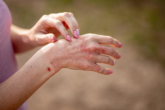 Zdjęcie bliska zapalenie skóry na skórze chory wysypka alergiczna egzema skóra pacjenta objaw atopowego zapalenia skóry detal skóry tekstura grzyb skóry koncepcja dermatologia leczenie grzybicze