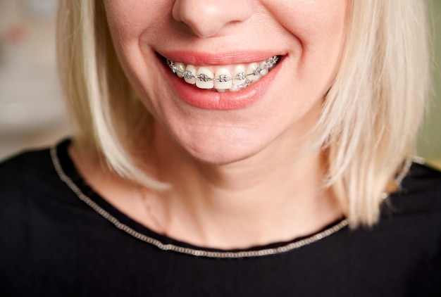 Zdjęcie blondynka z metalowymi szelkami na zębach