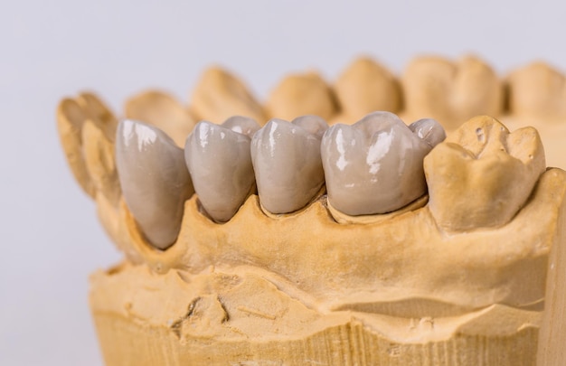 Ceramiczne implanty dentystyczne