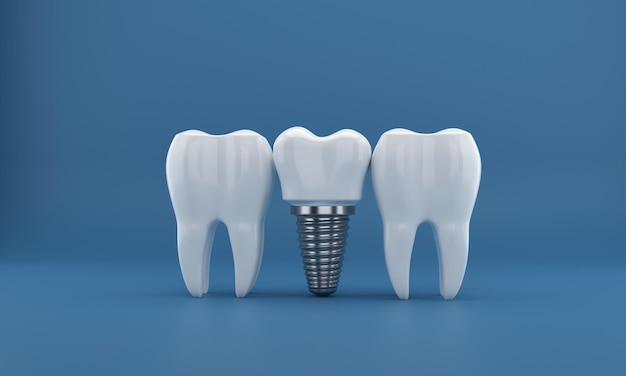 Chirurgia implantów dentystycznych renderowanie 3d