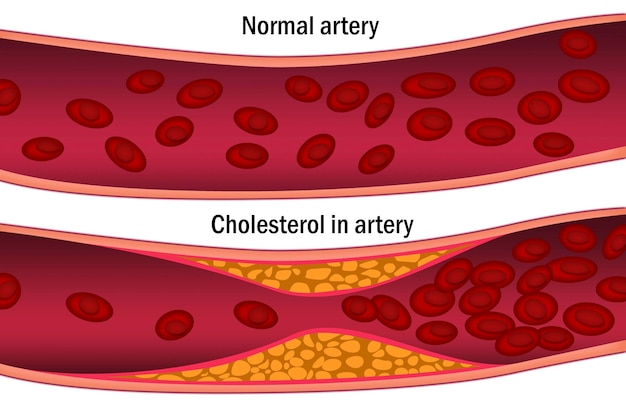 Cholesterol w tętnicy Koncepcja medyczna