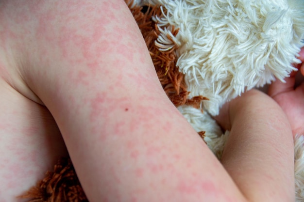 Choroba wirusowa odry wysypka na ciele dziecka Alergia
