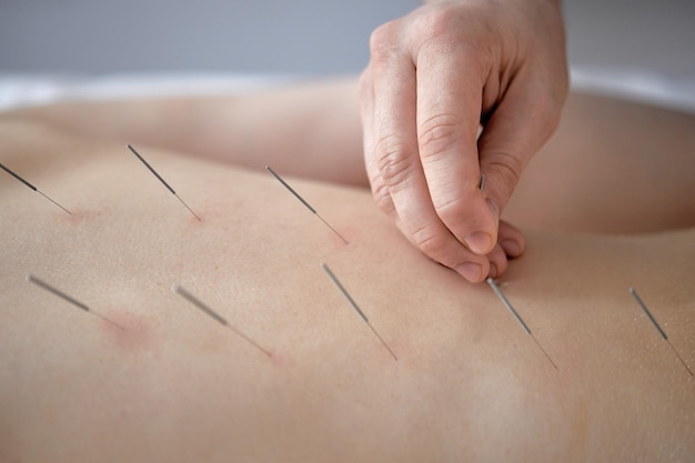 Cropped Acupuncturist Leczy Chorobę Pacjenta Za Pomocą Akupunktury W Specjalnych Punktach Na Plecach