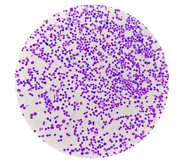 Cytologia płynu maziowego wykazująca dużą liczbę leukocytów w celu zdiagnozowania zapalenia stawów.