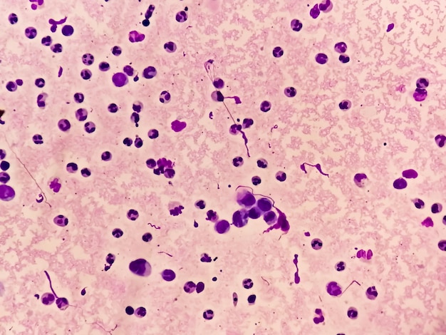 Cytologia płynu maziowego wykazująca dużą liczbę leukocytów w celu zdiagnozowania zapalenia stawów.