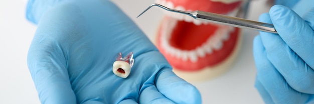 Dentysta lekarz w rękawiczce pokazuje koncepcję objawów infekcji kanału korzeniowego zęba