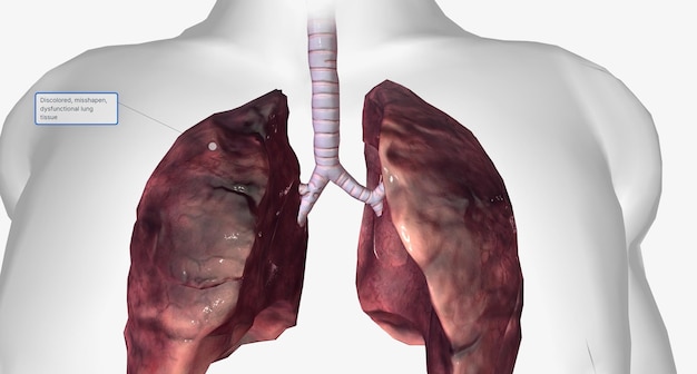 Długotrwałe narażenie na czynniki drażniące, takie jak dym papierosowy, może spowodować trwałe uszkodzenie płuc i dróg oddechowych