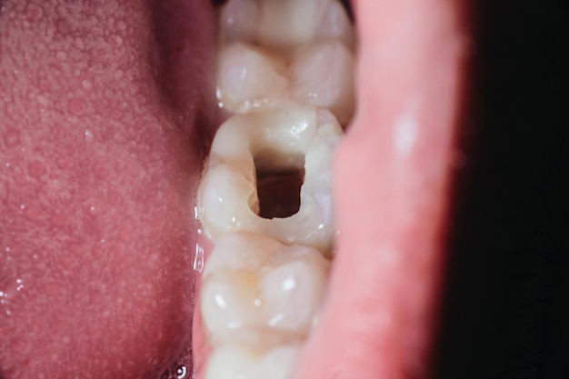 Zdjęcie duży otwór w zębie żującym wywiercony przez dentystę do leczenia