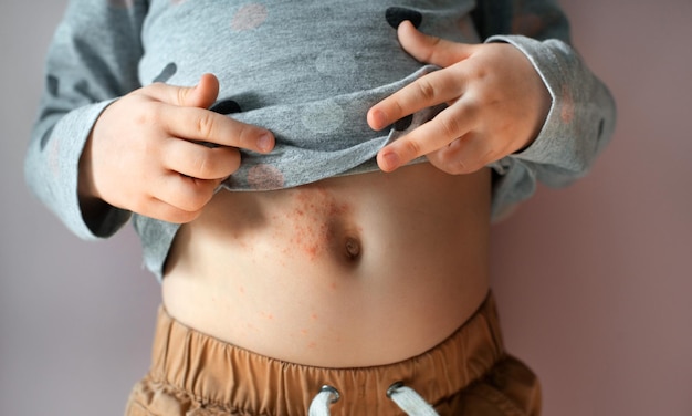 Dziecko ospy wietrznej Wirus ospy wietrznej i półpaśca lub wysypka świerzbu u dziecka