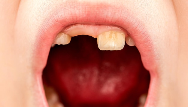 Dziecko z uszkodzonymi zębami Portret chłopca z uszkodzonymi zębami Dziecko uśmiecha się i pokazuje stłoczony ząb Zbliżenie niezdrowych zębów dziecka Pacjent z otwartymi ustami, pokazujący próchnicę zębów