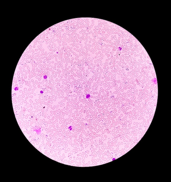 Dziedziczna niedokrwistość hemolityczna lub choroba hemoglobiny E pod mikroskopem