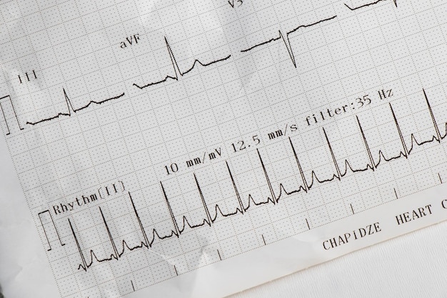 Zdjęcie fale kardiogramu bicia serca ekg na papierze