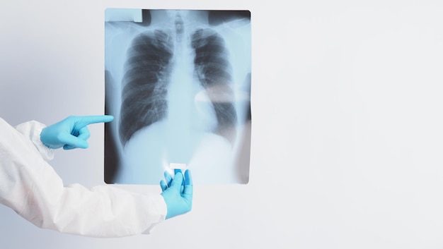 Film rentgenowski uszkodzenia płuc Covid 19 i trzymania ręką lekarza