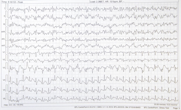 Zdjęcie graficzny elektrokardiogram ekg osoby z chorobą serca