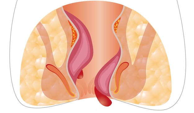 Hemoroidy Niezdrowa dolna odbytnica z ilustracją stanu zapalnego struktur naczyniowych