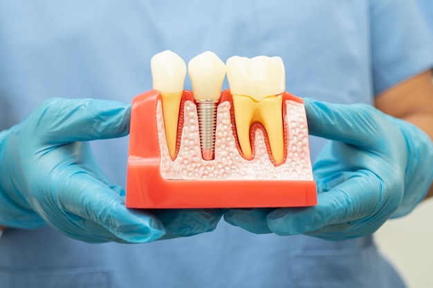 Implant dentystyczny sztuczne korzenie zębów w kanał korzeniowy szczęki leczenia zębów choroba dziąseł model zębów dla dentystów studiujących stomatologię