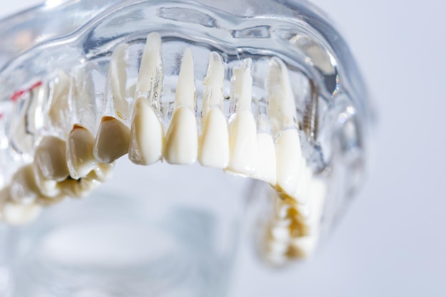 Implant dentystyczny sztuczne korzenie zębów w kanał korzeniowy szczęki leczenia zębów