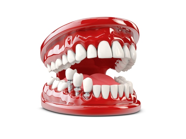 Implant zęba ludzkiego. Koncepcja dentystyczna 3d ilustracja.