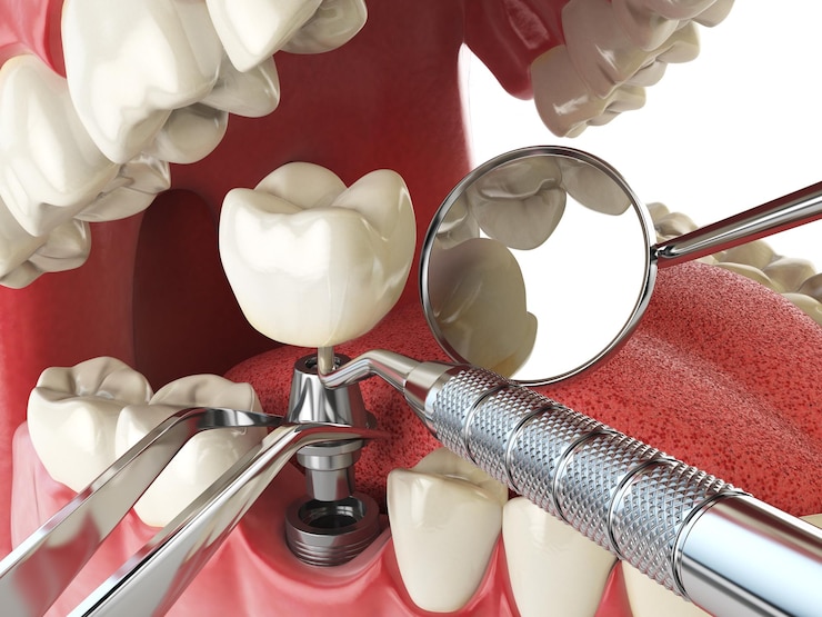 Zdjęcie implant zęba ludzkiego koncepcja implantacji zębów ludzkie zęby lub protezy i narzędzia dentystyczne