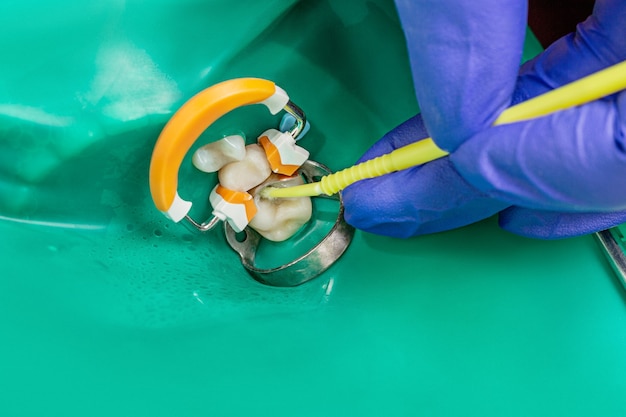 Instrumenty stomatologiczne Microbrush w leczeniu próchnicy dłoni lekarzy Zbliżenie