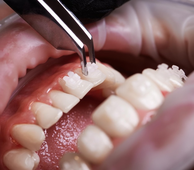 Kleszcze Dentystyczne Do Przymocowania Wspornika Do Dolnego Zęba