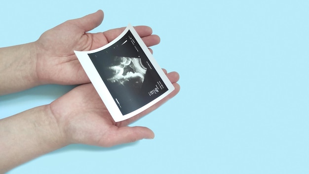 Kobiece ręce trzymają prenatalne badanie ultrasonograficzne planu nienarodzonego dziecka na niebieskim tle