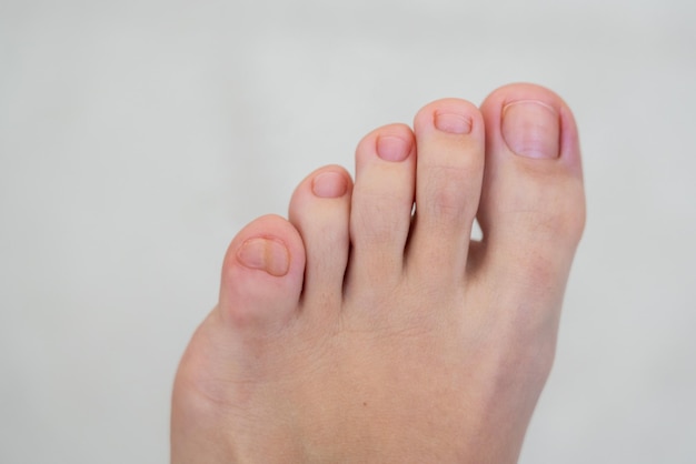 Kobiece stopy z dużym podwójnym małym palcem na białym tle
