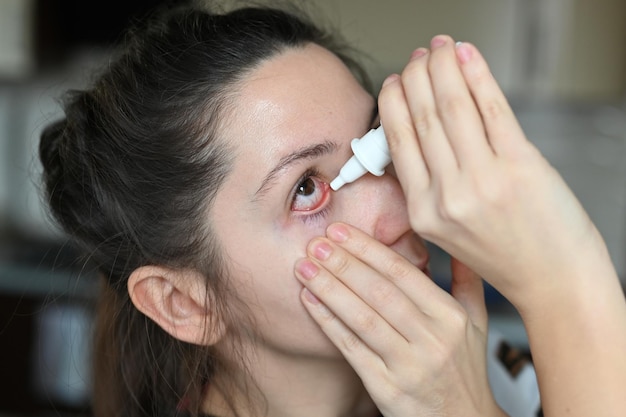 Zdjęcie kobieta ociekająca kroplami leczniczymi z oczu zbliżenie zapalenie brązowe oczy z czerwonymi żyłami zespół suchego oka