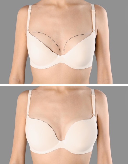 Zdjęcie kobieta przed i po powiększeniu piersi na jasnoszarym tle zbliżenie