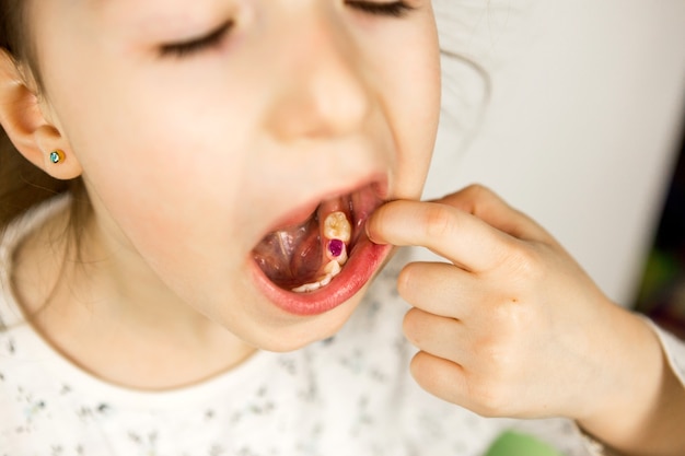 Kolorowe, fioletowe wypełnienie na mlecznym zębie dziewczynki. Stomatologia dziecięca, leczenie i badanie. Dziecko z otwartymi ustami pokazuje ząb w zbliżeniu na białym tle.