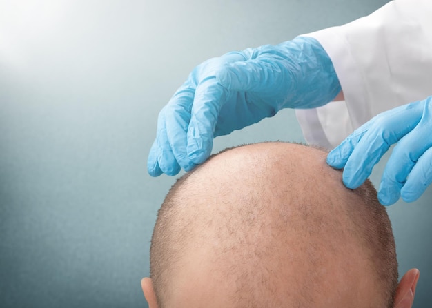 Koncepcja przeszczepu włosów z nowoczesną techniką