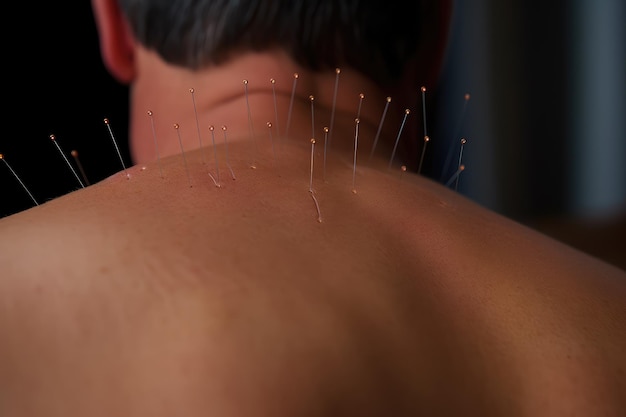 Leczenie akupunkturą cienkimi igłami na skórze pleców