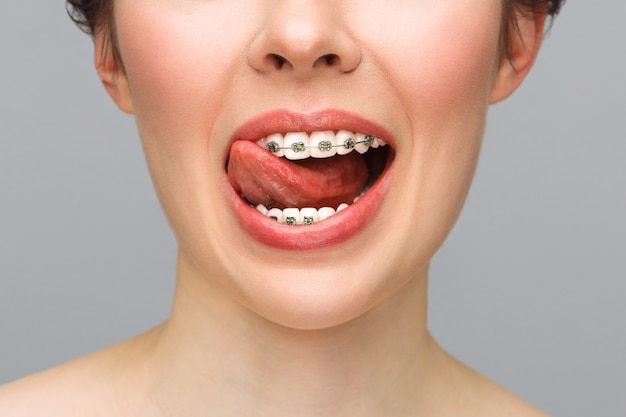 Leczenie ortodontyczne koncepcja opieki stomatologicznej zbliżenie ceramiczne i metalowe zamki na zębach piękne