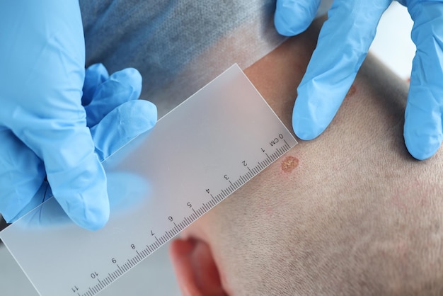 Lekarz dermatolog bada znamię pacjenta w poradni dermatologicznej profilaktyka chorób i