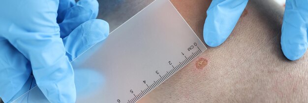 Lekarz dermatolog bada znamię pacjenta w poradni dermatologicznej profilaktyka chorób i