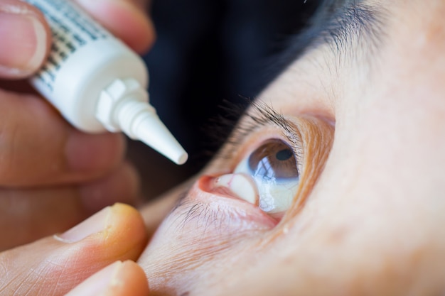 Lekarz nakłada żel do sztucznych łez na oko pacjenta